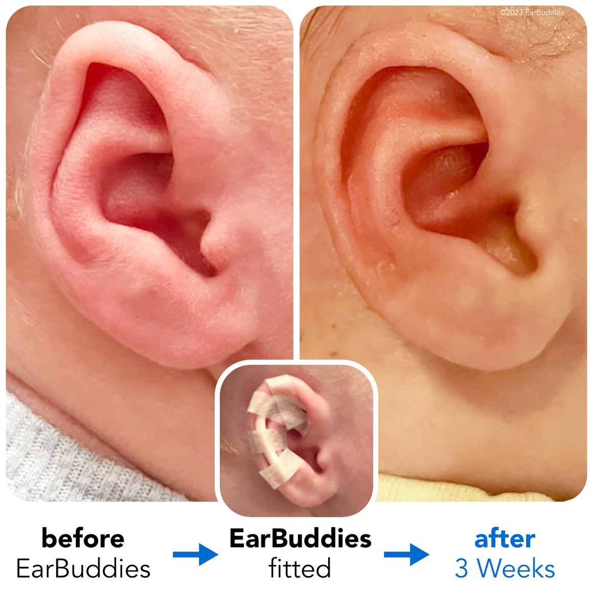 baby elfin ears, sharing my expereince using earbuddies(TM) on my baby